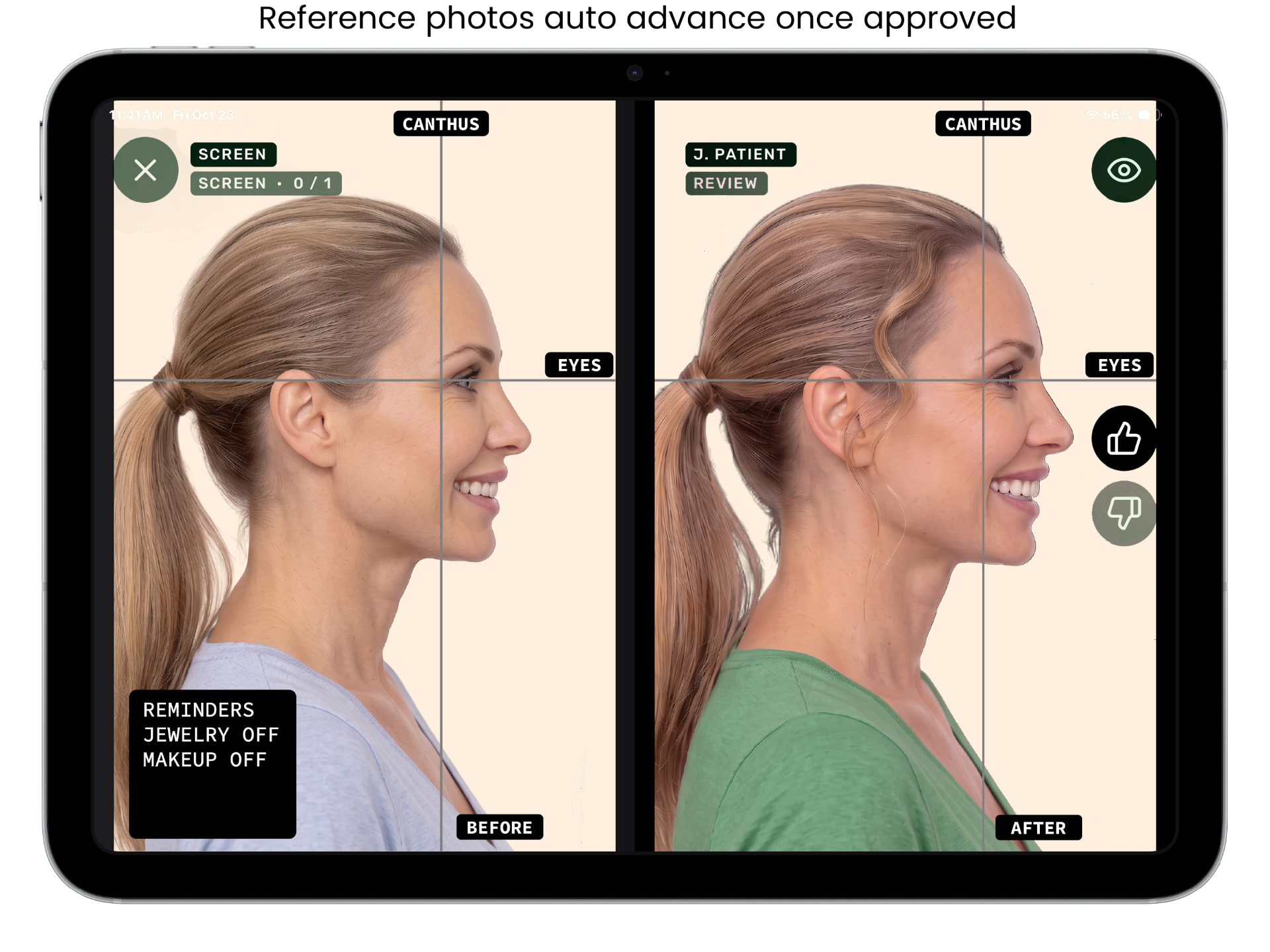 ALIGN before and after capture screen, example 3 of 9