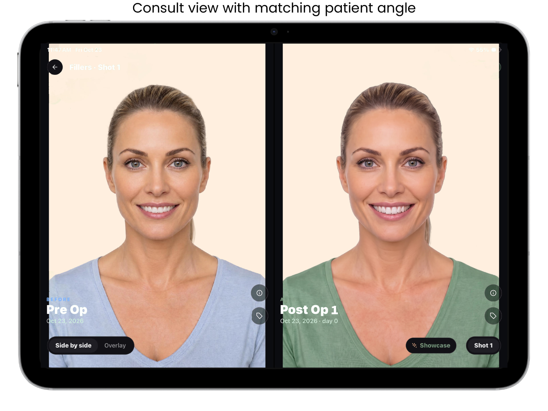 ALIGN before and after capture screen, example 6 of 9