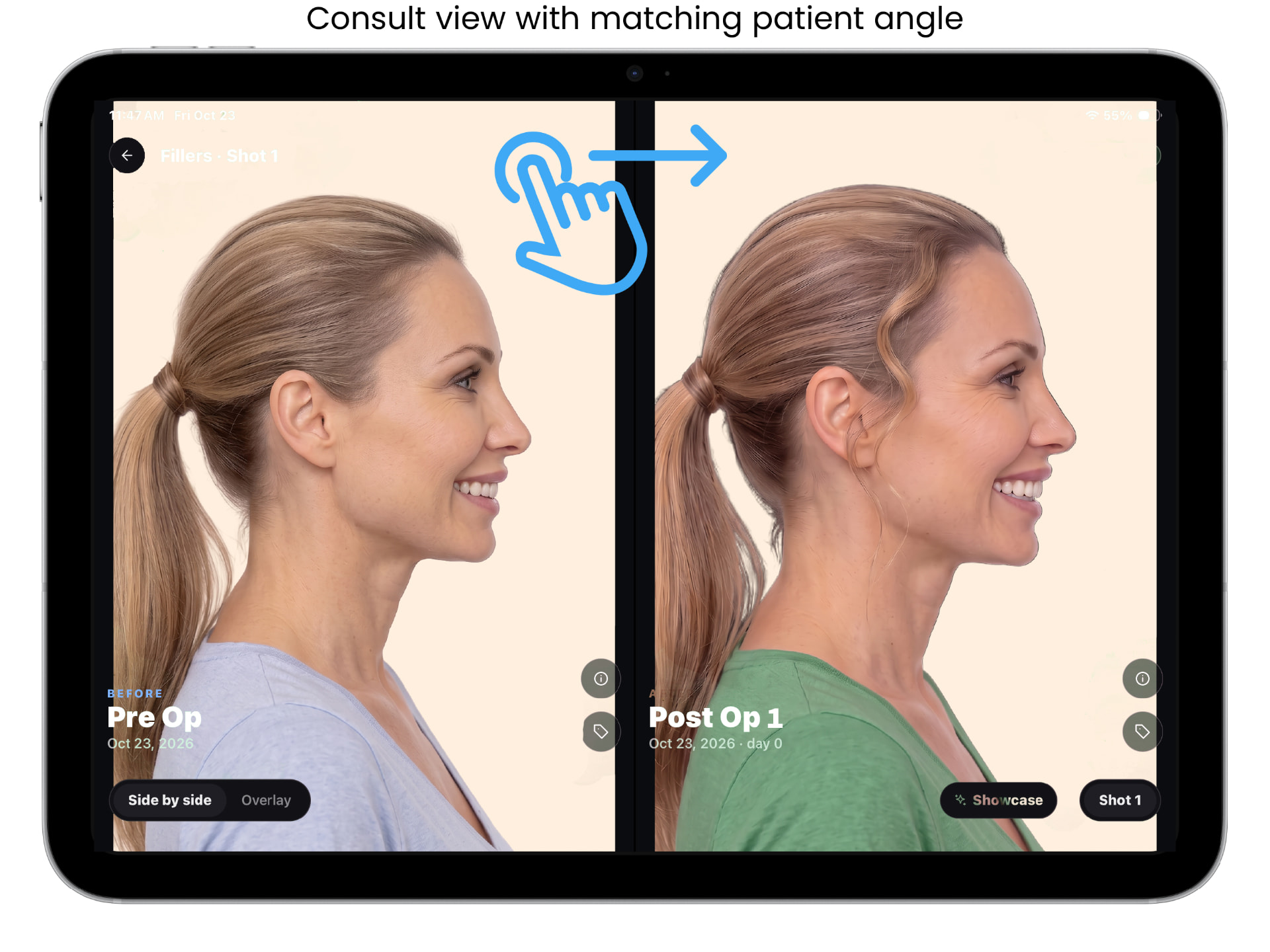 ALIGN before and after capture screen, example 4 of 9