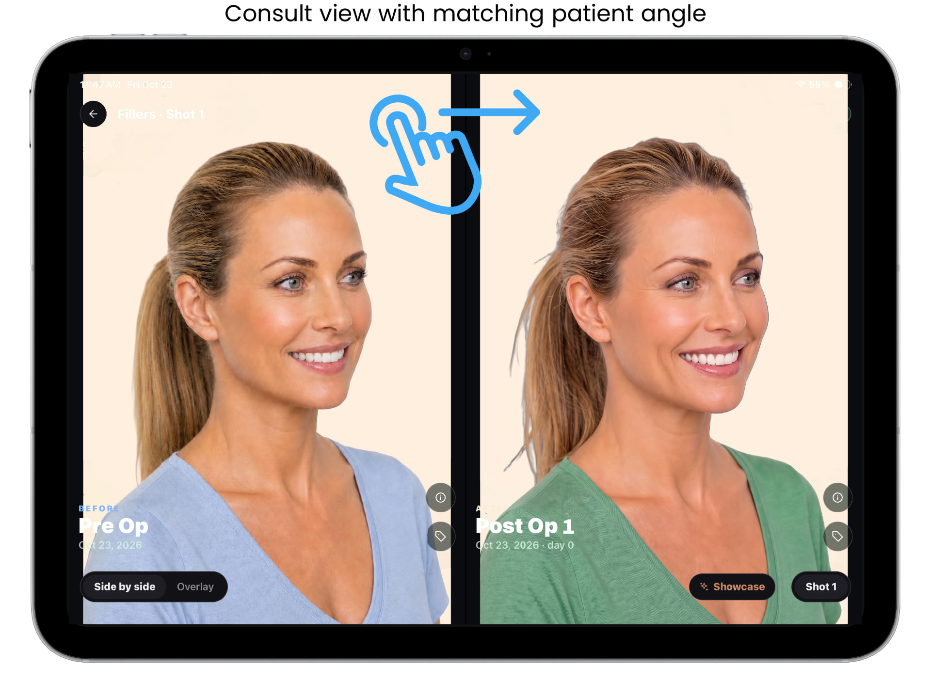 ALIGN before and after capture screen, example 5 of 9